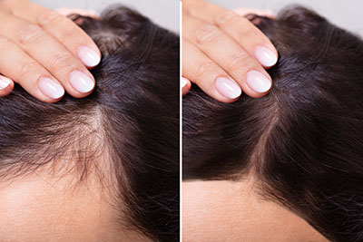 Non-Surgical Options for Hair Regrowth Carrollwood