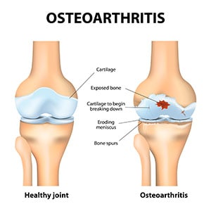 Non-Surgical Treatment for Osteoarthritis Riverview, FL