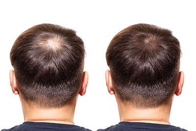 What Causes Hair Loss Tampa